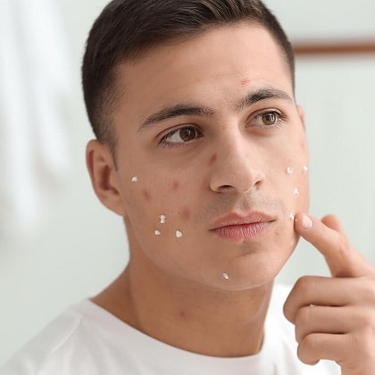 Acne: More Than Skin Deep?