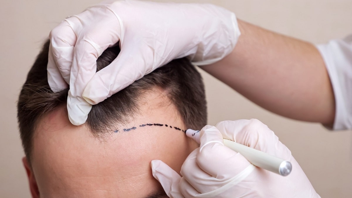 Easy Ways to Find Good Hair Transplant Services