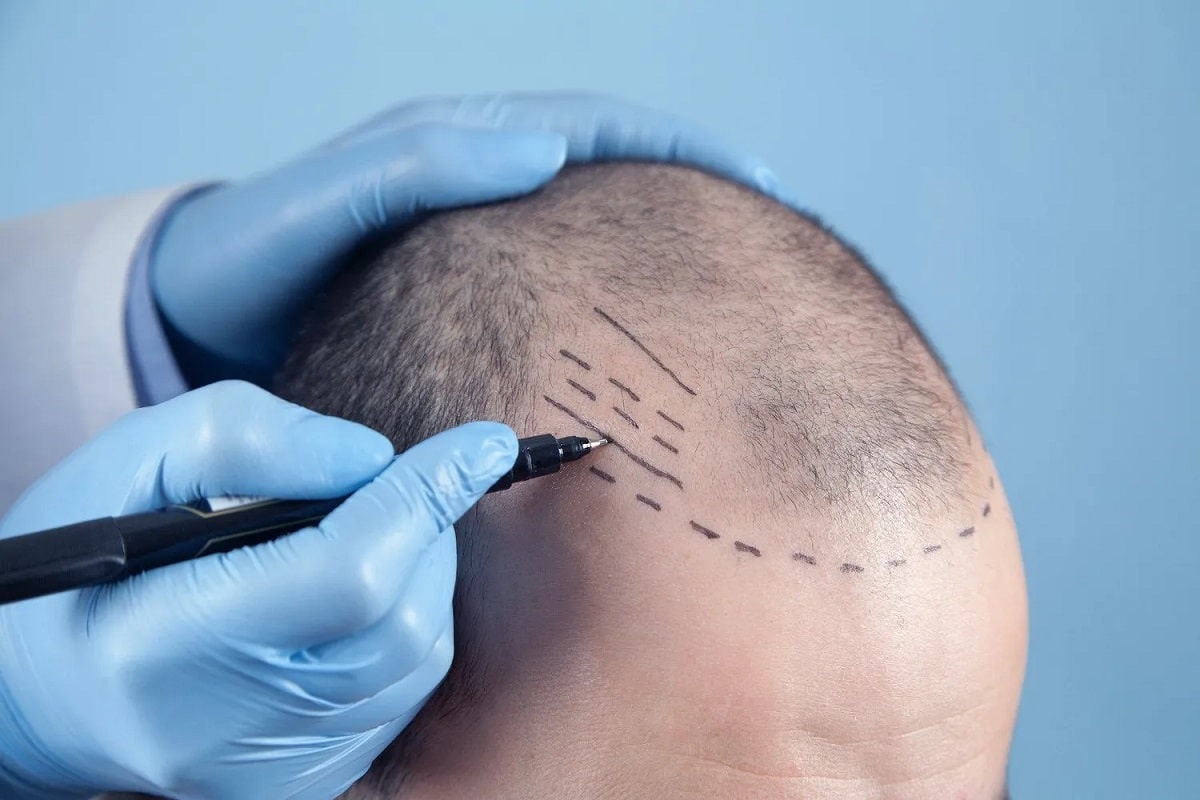 Is a Hair Transplantation Right for Me?